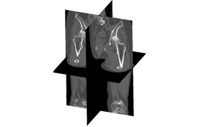 Pelvic Tilt Estimation Using Depth Maps from a Single Plain Radiograph